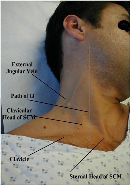 Image showing neck vein landmarks